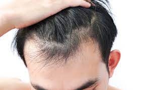Elevate Your Hair Health The PRP Treatment Experience